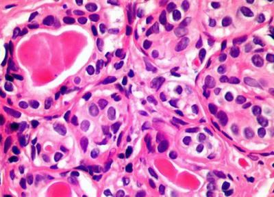 سلول تی شاید همه سرطان ها را معالجه کند